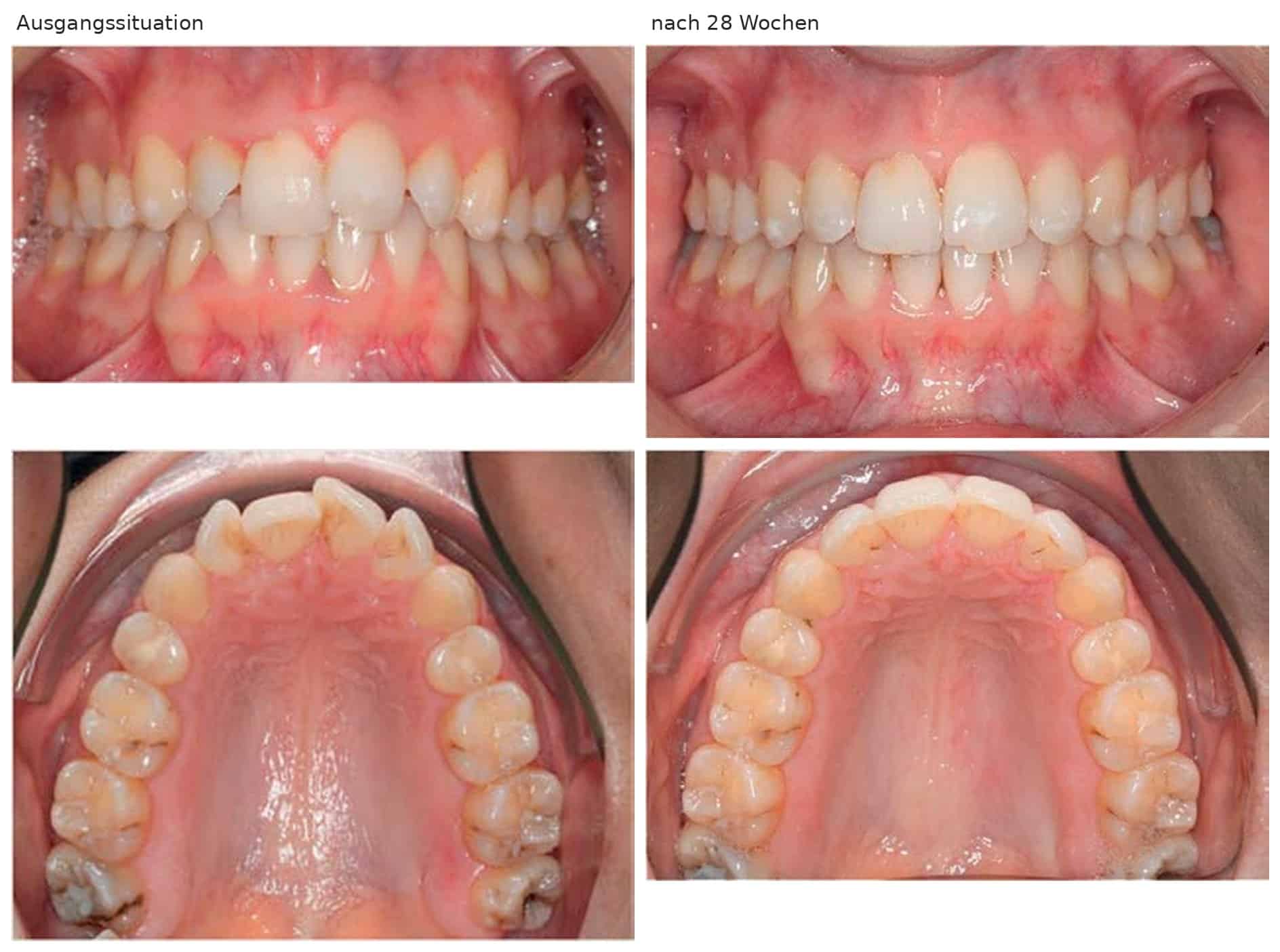 Intraoral photos: frontal view and view of the upper jaw, left with crowded and rotated teeth at the start of treatment, right after 28 weeks with an expanded dental arch