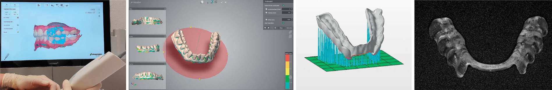 Production of a plastic splint: intraoral scan on screen, digital planning on tooth model, virtual print preparation, finished transparent splint