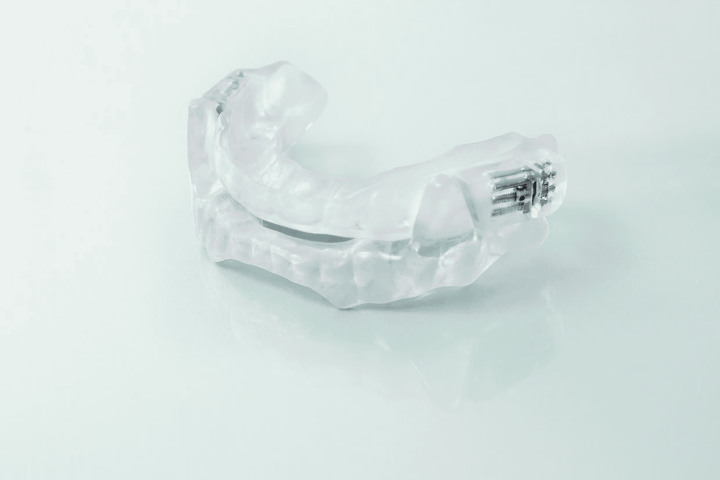 3D-gedruckte, transparente Schnarchschiene mit Stellschrauben, verwendet zur Behandlung von Schnarchen und Schlafapnoe.