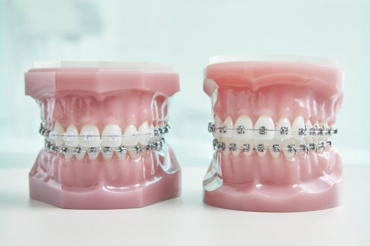 Kieferorthopaede Koeln - JUST KFO - Dr. Steinmaier + Kollegen - Labor - Damon Brackets - Keramik Brackets - selbstlegierende Brackets