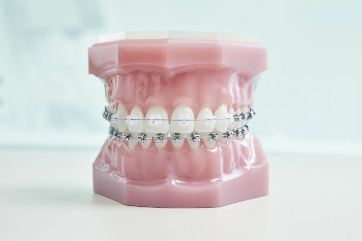 Kieferorthopaede Koeln - JUST KFO - Dr. Steinmaier + Kollegen - Labor - Feste Zahnspange Keramikbrackets