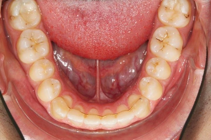 Kieferorthopaede Koeln - JUST KFO - Dr. Steinmaier + Kollegen - Retention - Retainer